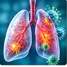 Pneumonia illustration